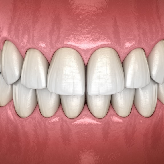 Animated smile showing irregular tooth texture
