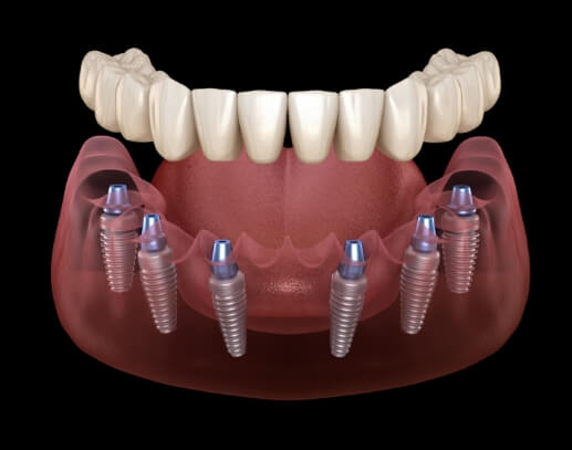 Animated smile during traditional dental implant denture placement