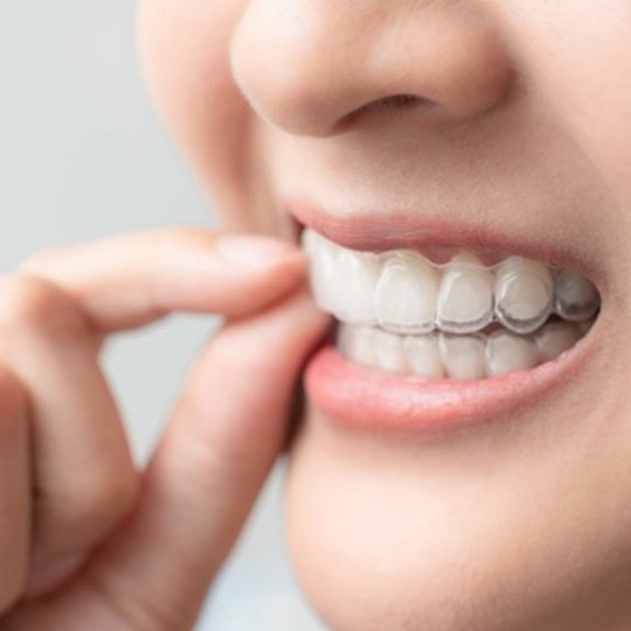 a person wearing Invisalign aligners