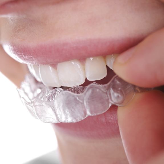 Closeup of person placing an Invisalign tray