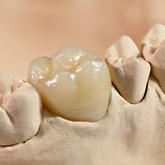 Model smile with metal free dental restoration