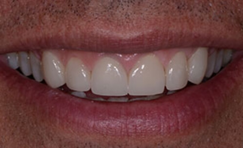 Closeup of smile after cosmetic dentistry