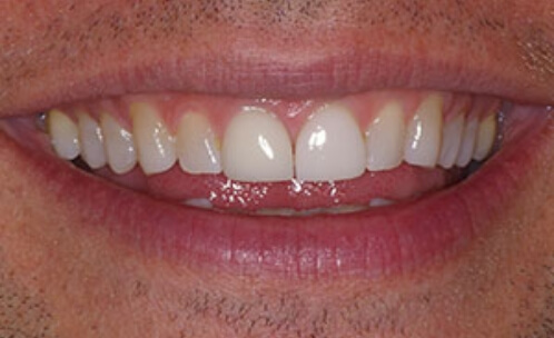 Closeup of smile before cosmetic dentistry