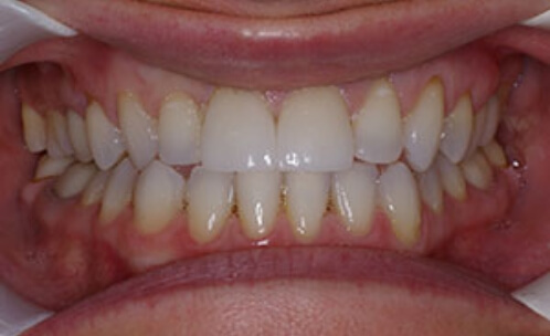 Closeup of smile with repaired top front tooth