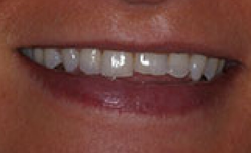 Closeup of smile with broken top front tooth