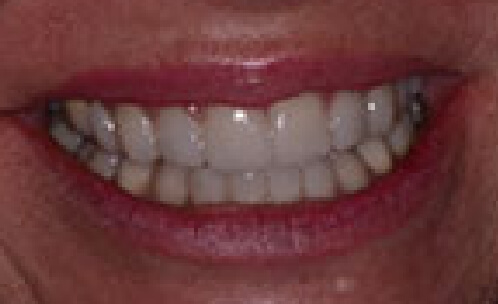 Closeup of smile after teeth whitening