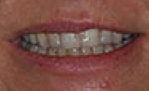 Closeup of discolored smile before teeth whitening