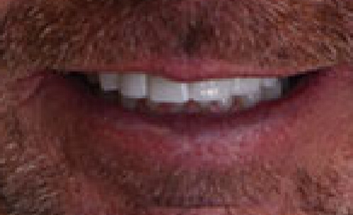 Closeup of perfectly aligned smile after orthodontic treatment