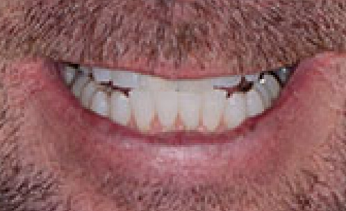 Closeup of smile with underbite before orthodontics treatment
