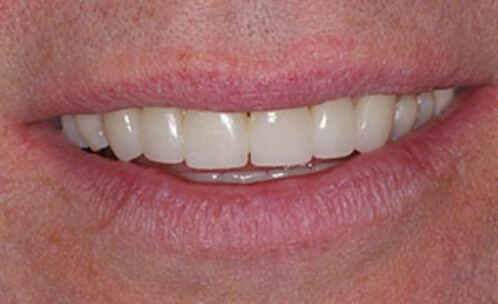 Bright smile after cosmetic dentistry