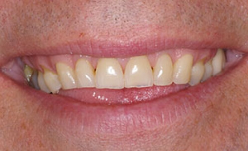 Discolored smile before cosmetic dentistry