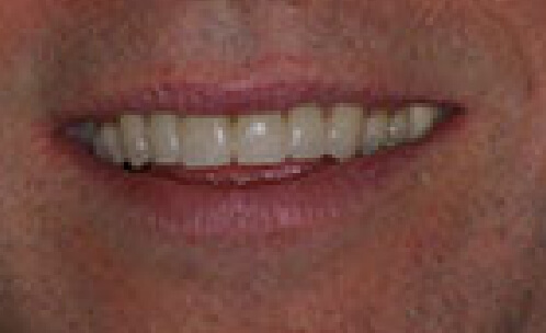 Perfected smile after cosmetic dentistry