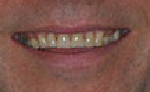 Smile with several small flaws before cosmetic dentistry