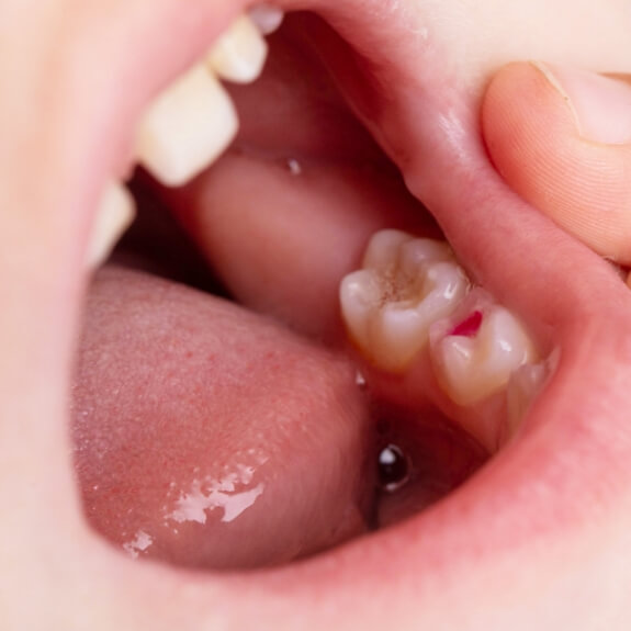 Dentist examining smile during tooth colored filling treatment