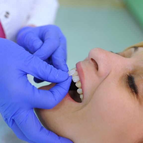 Cosmetic dentist placing a porcelain veneer