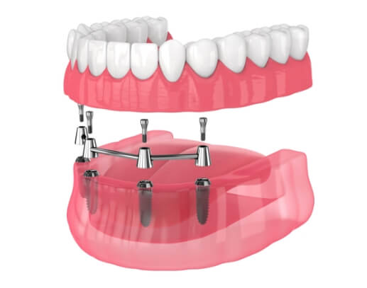 Animated smile during bar retained dental implant supported denture placement
