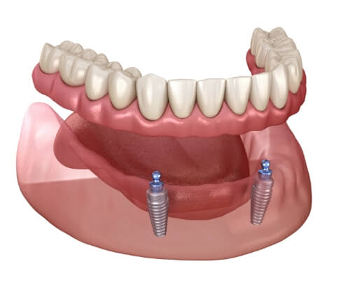 Animated smile during ball retained dental implant denture placement