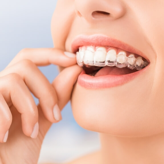 Closeup of person placing a clear aligner