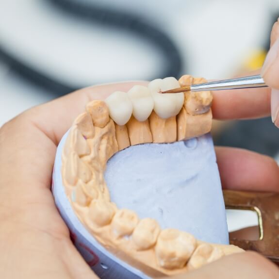 Model smile with dental bridge