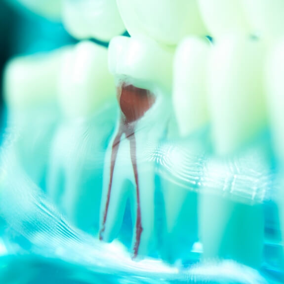 Model tooth demonstrating results of a root canal procedure