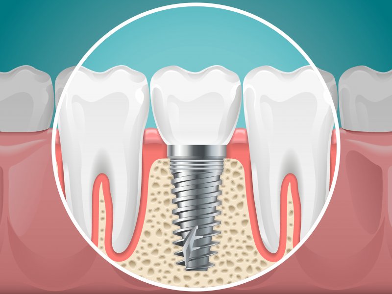 Illustration of dental implant