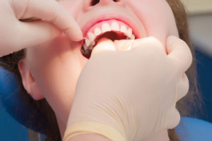 woman teeth flossed by dentist in Dublin